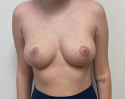Breast Lift (Mastopexy) with or without implants